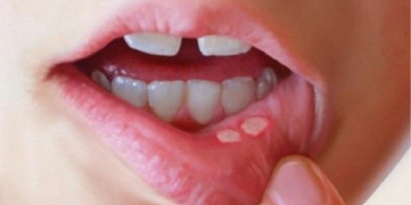 راه ساده درمان آفت دهان